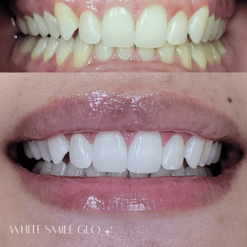 White Smile 10