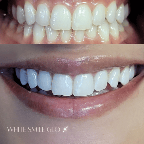 White Smile 13