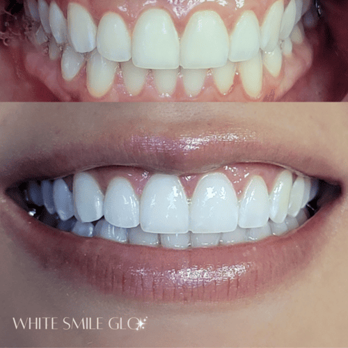 White Smile 14