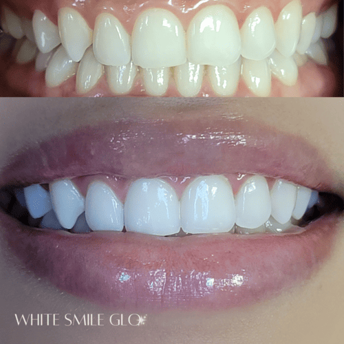 White Smile 16