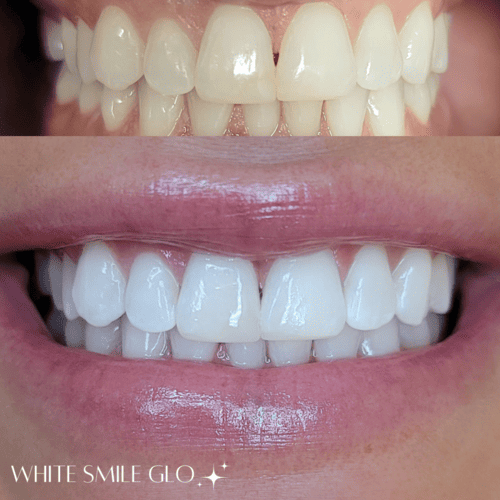 White Smile 4